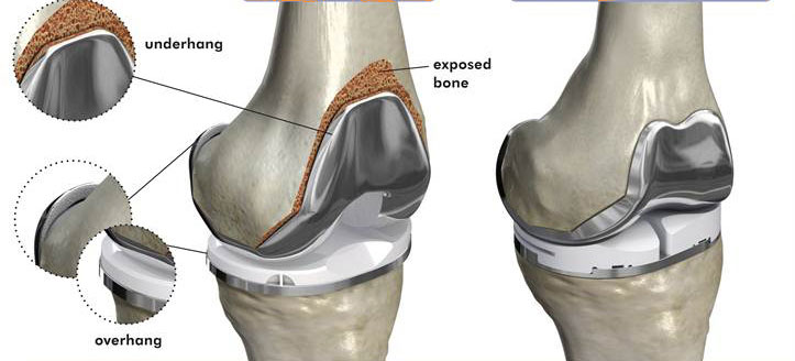 Best Knee Replacement Surgeon in Dehradun 